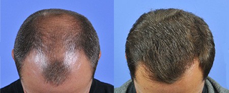 Gabel Hair Restoration Center