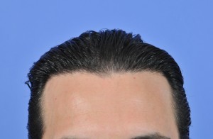 Frontal Hairline - Gabel Hair Restoration Center - FUE and Strip ...